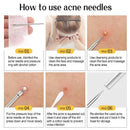 1/11Pcs Acne Pimples Blackhead Remover Clip Ultra-fine Tweezers Black Dots Blackhead Extractor Acne Needle Facial Cleaner Skin